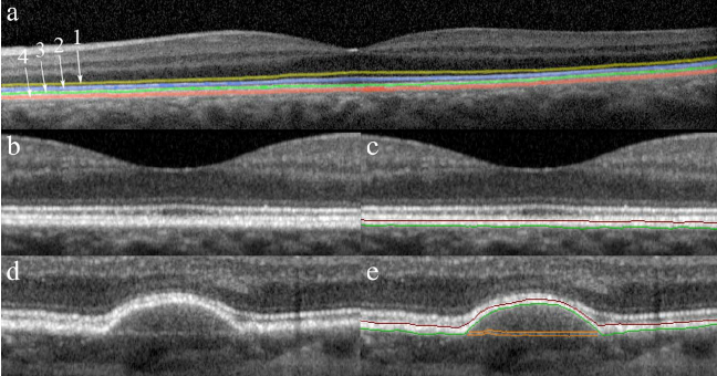 Different retinal layers in OCT